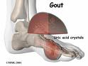 gout in foot