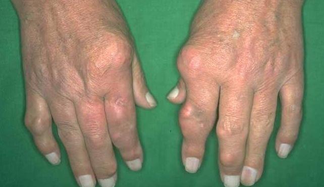 gout in both hands